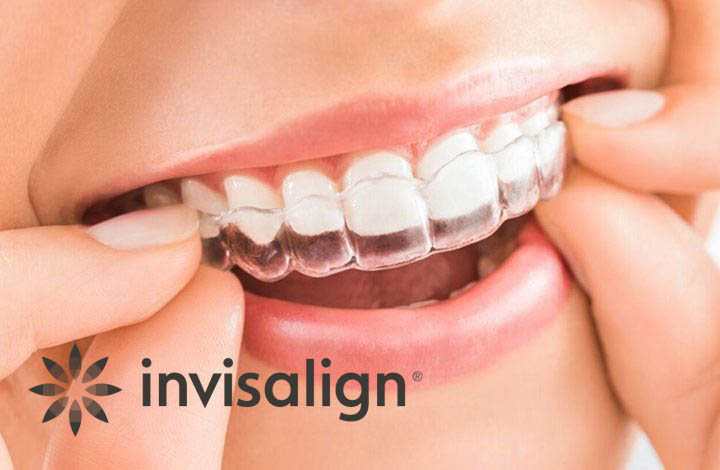 what-is-invisalign-720×470